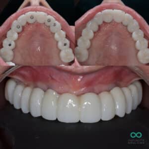 full arch same day teeth dental implants showing the fixtures