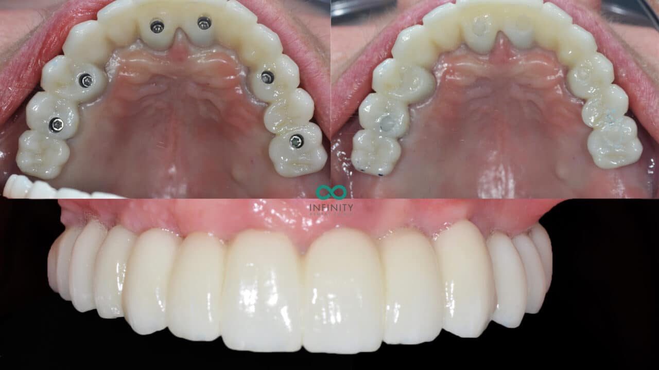 same day teeth dental implants