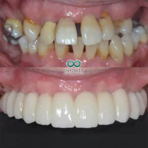 Full arch dental implants with gum contouring