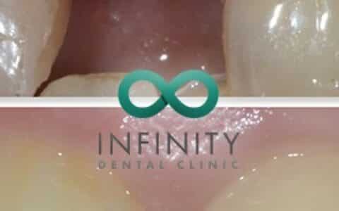 Infinity logo on teeth
