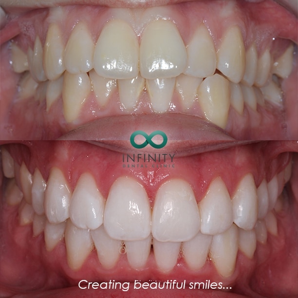 teeth whitening infinity dental clinic