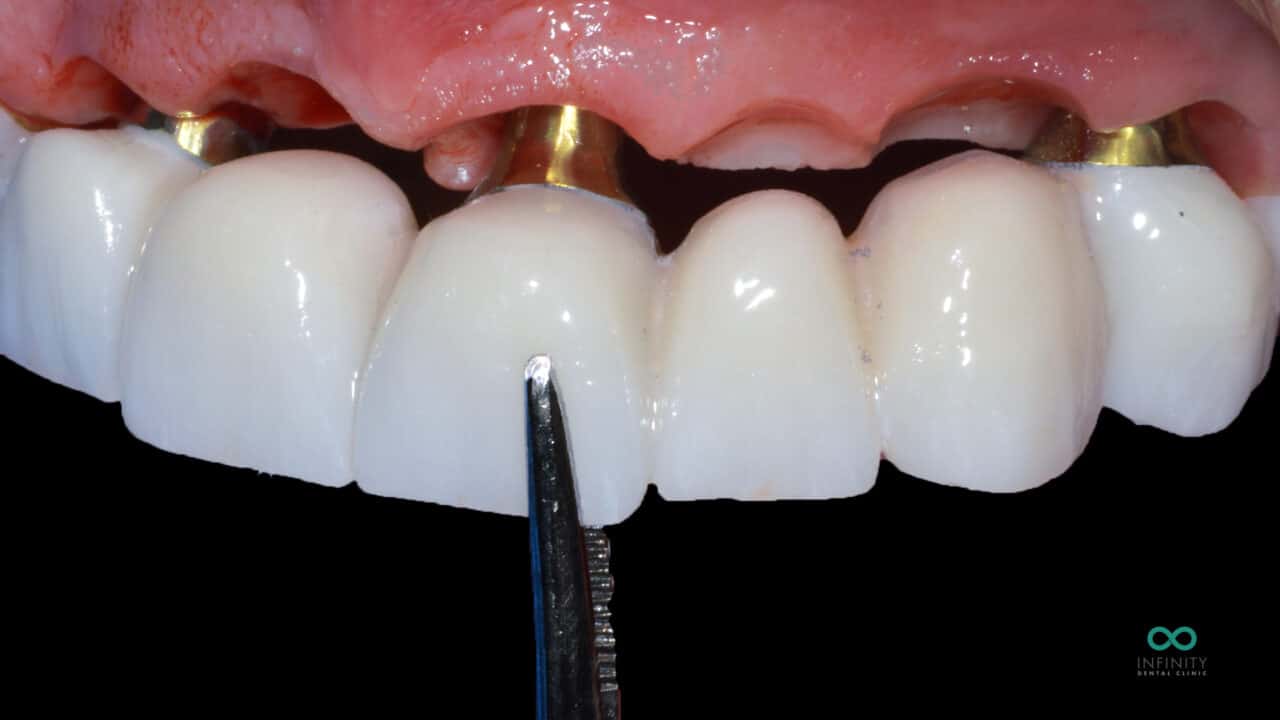 gum contouring dental implants infinity dental