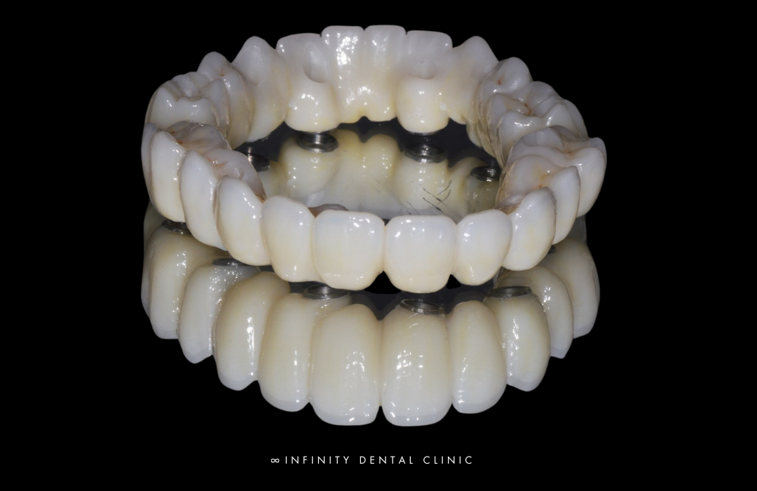 Full Arch Same Day Teeth Leeds Harrogate full arch same day teeth dental implants leeds and harrogate