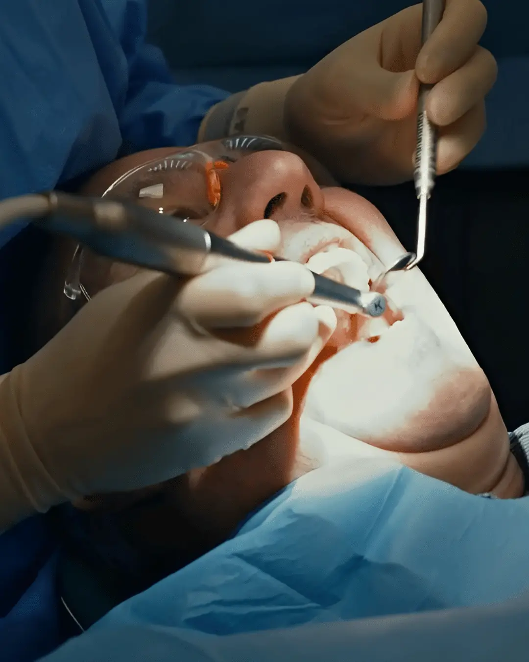 Dental surgeon performing implant placement procedure under surgical lighting with patient under local or IV sedation