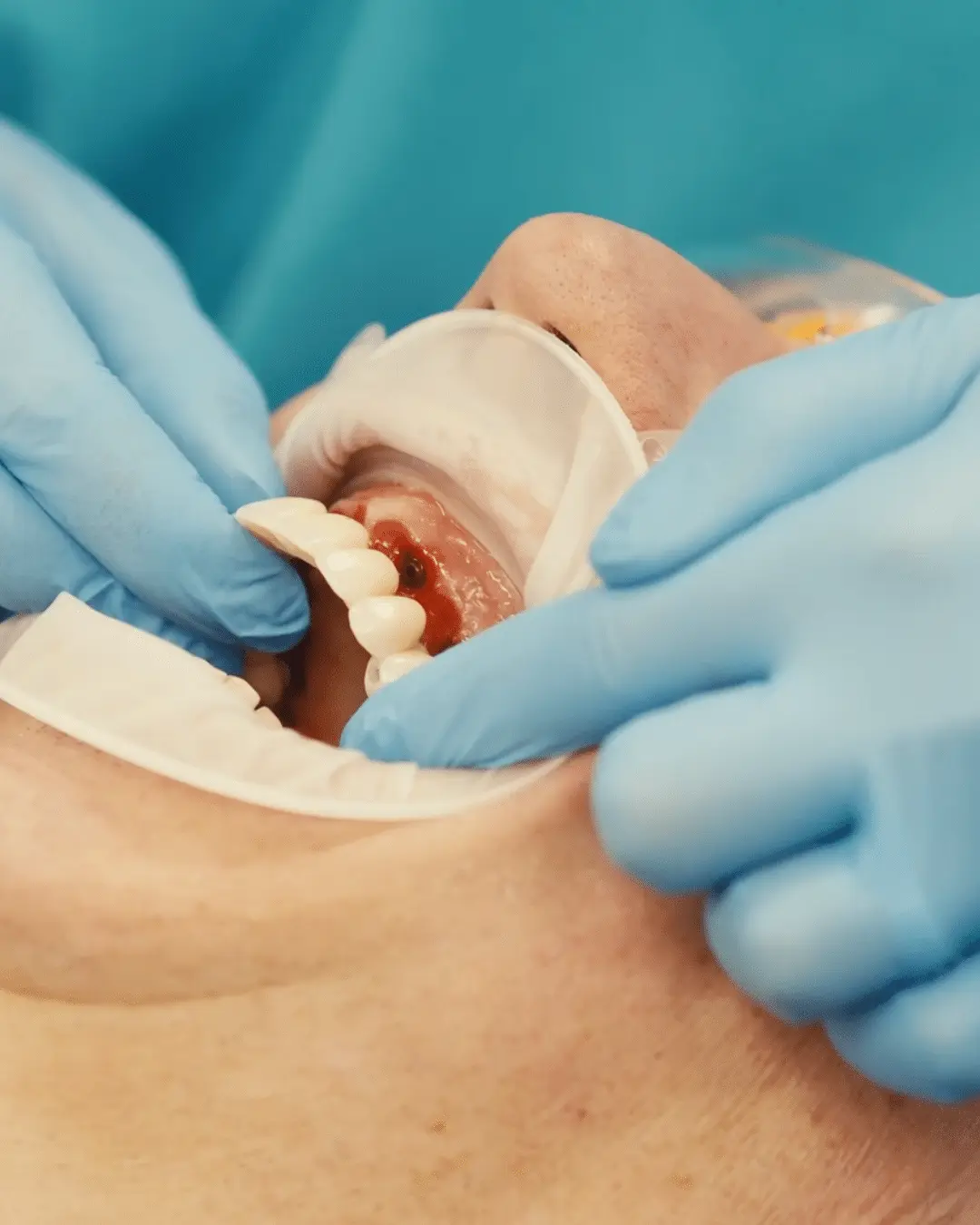 Dental professional fitting a temporary prosthesis over freshly placed full arch implants in a patient's upper jaw