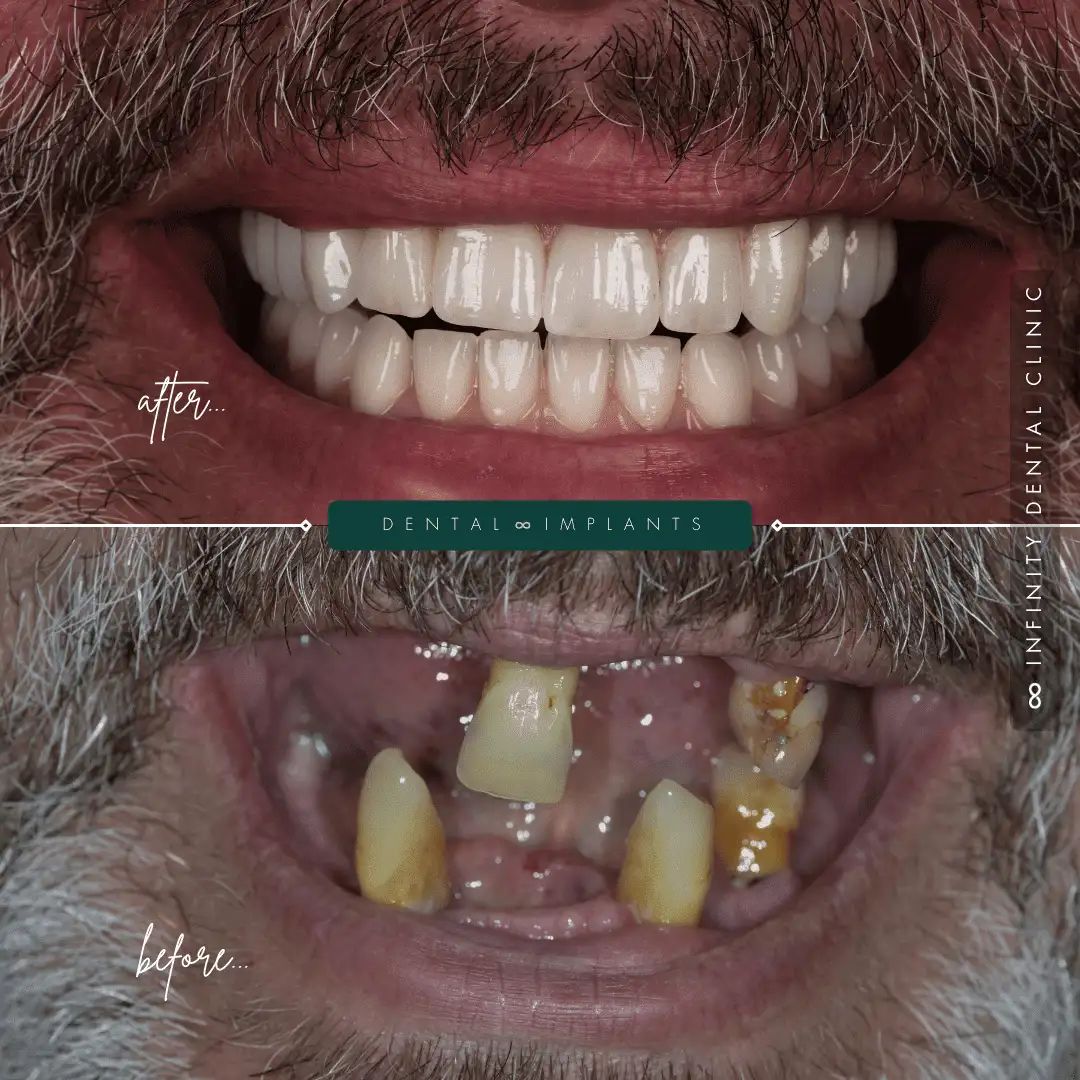 Before and after photo of a male patient treated with All-on-6 dental implants showing a complete transformation from failing teeth to a natural-looking full smile