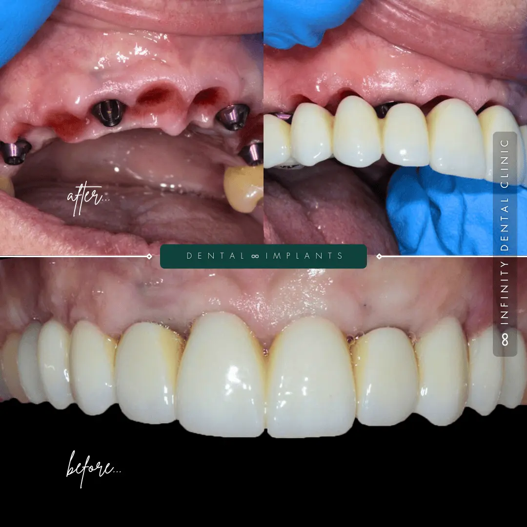 Before and after clinical images of a full arch dental implant treatment, including implant placement and final prosthesis fitting