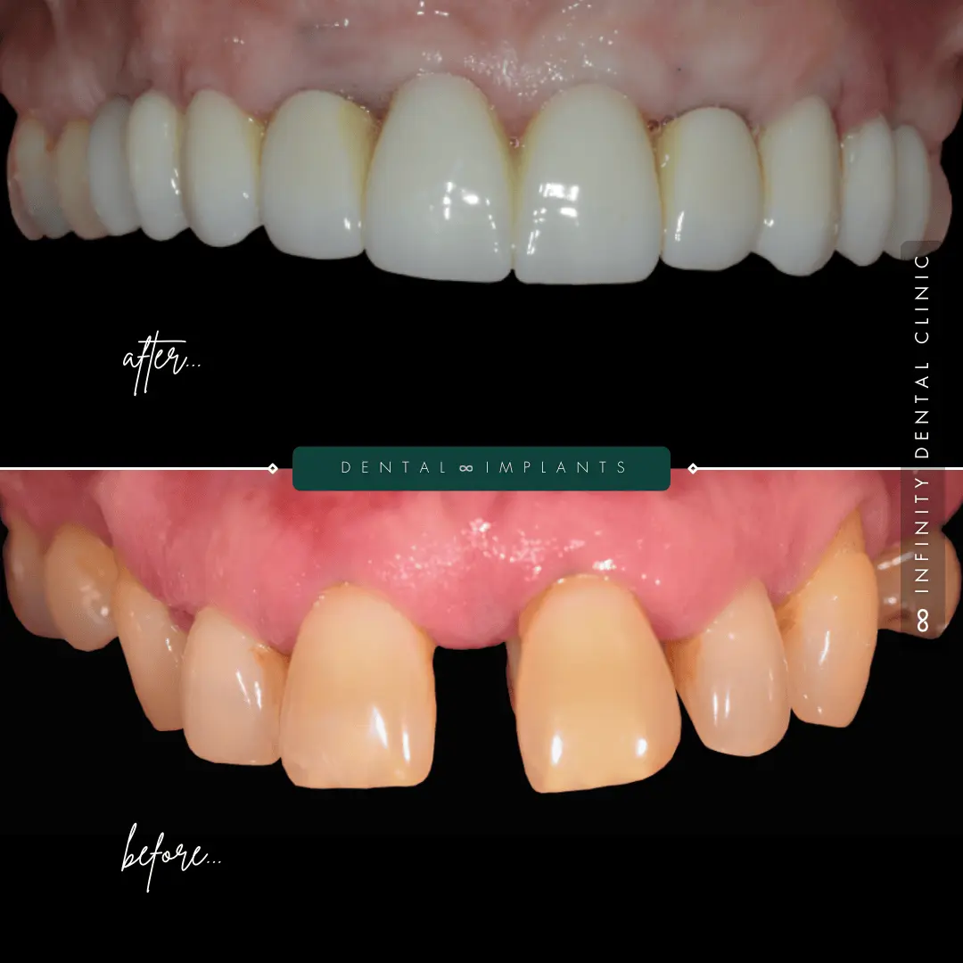 Before and after image of a patient receiving full arch dental implants to restore damaged and uneven front teeth