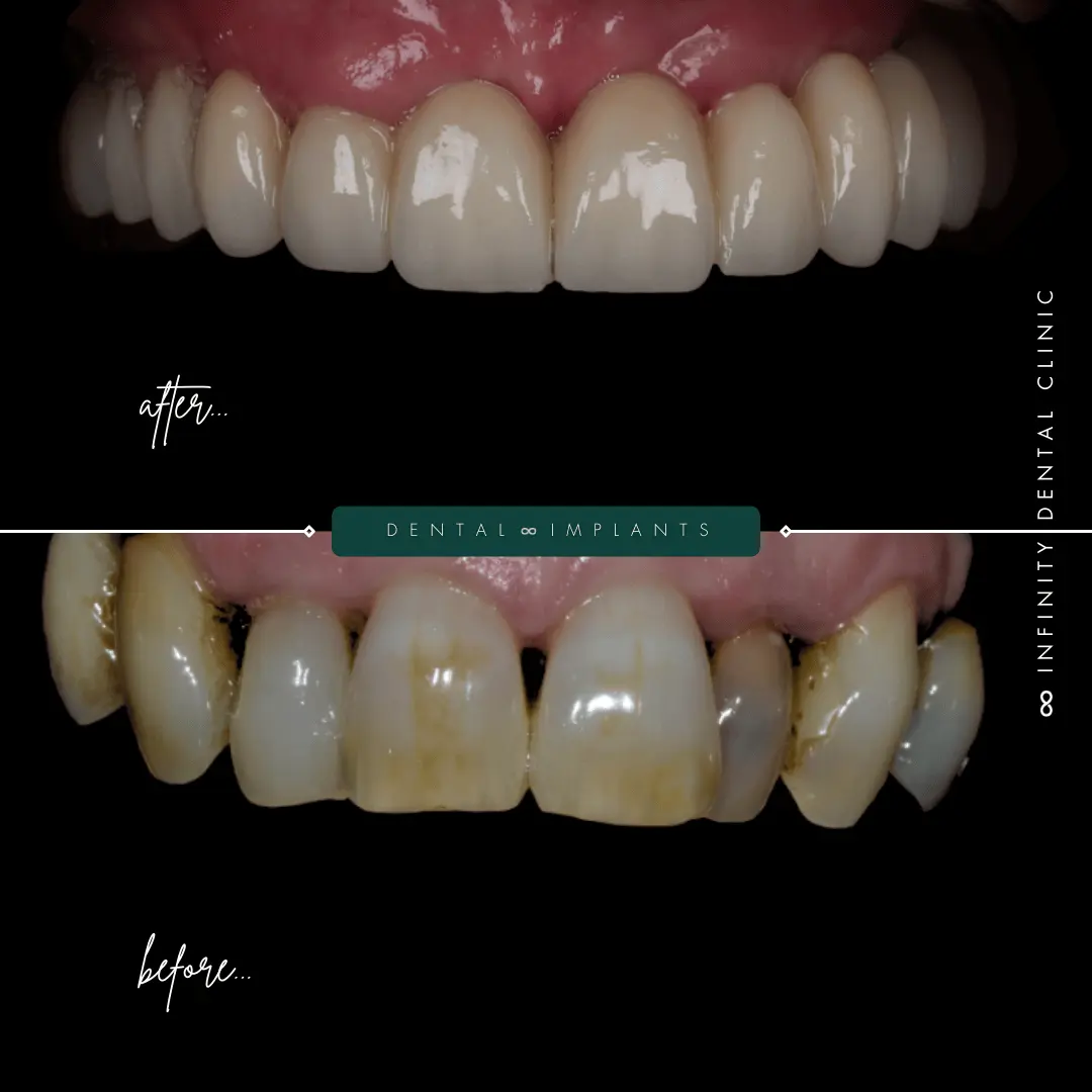 Close-up before and after image of full arch dental implant restoration showing severe tooth staining and damage replaced with natural-looking prosthetics