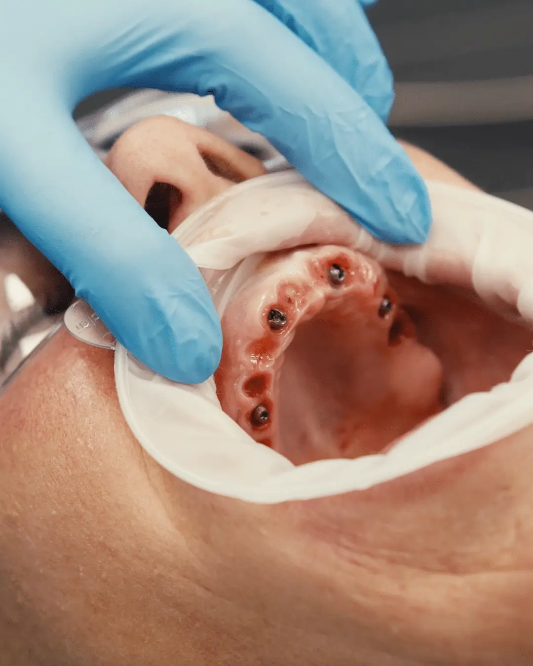 Intraoral view of freshly placed upper jaw dental implants during full arch surgery at Infinity Dental Clinic