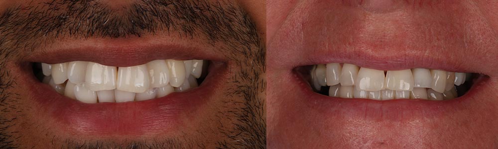 implant smiles leeds