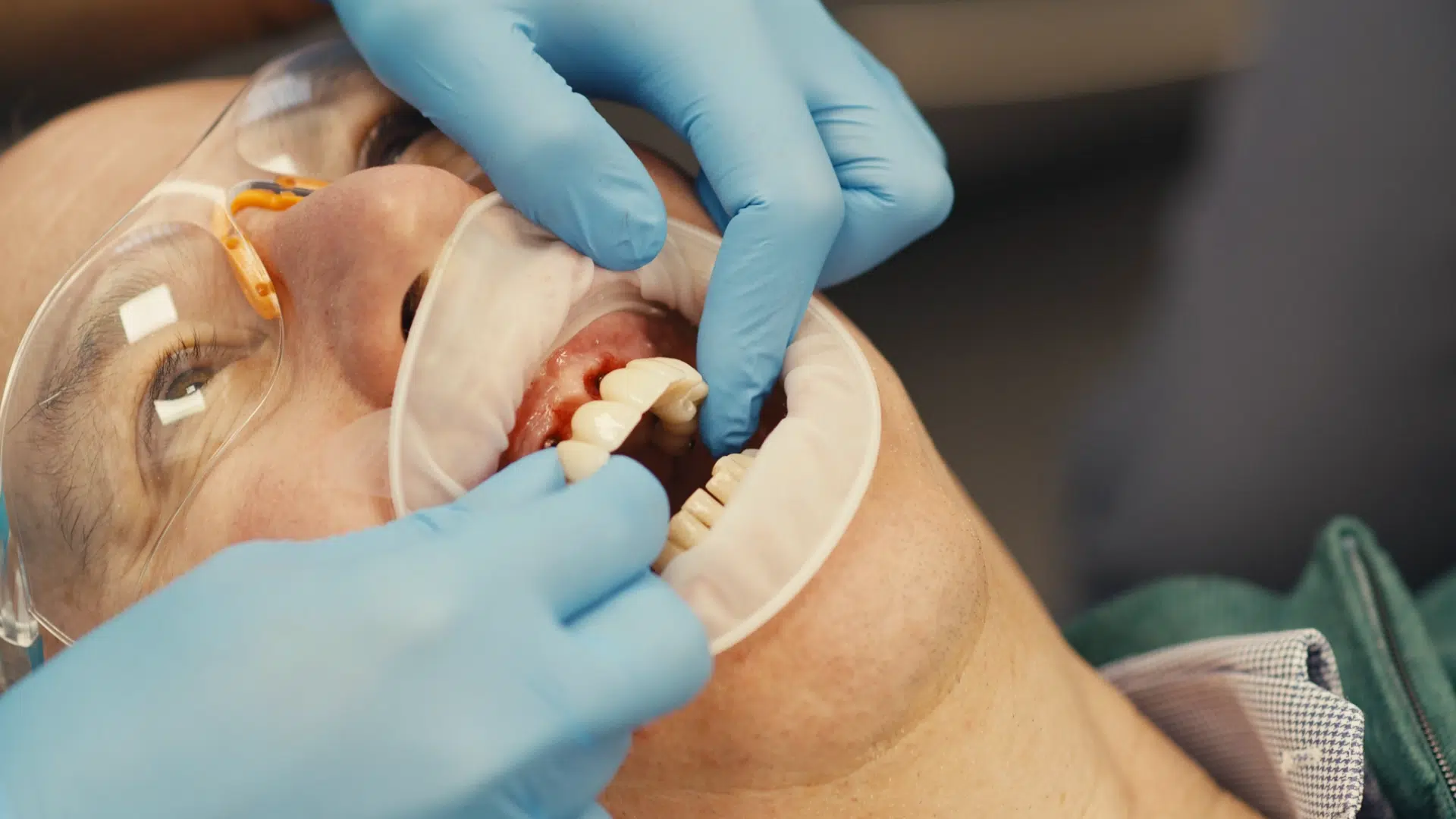 Dental Implants performed at Infinity Dental Leeds and Harrogate