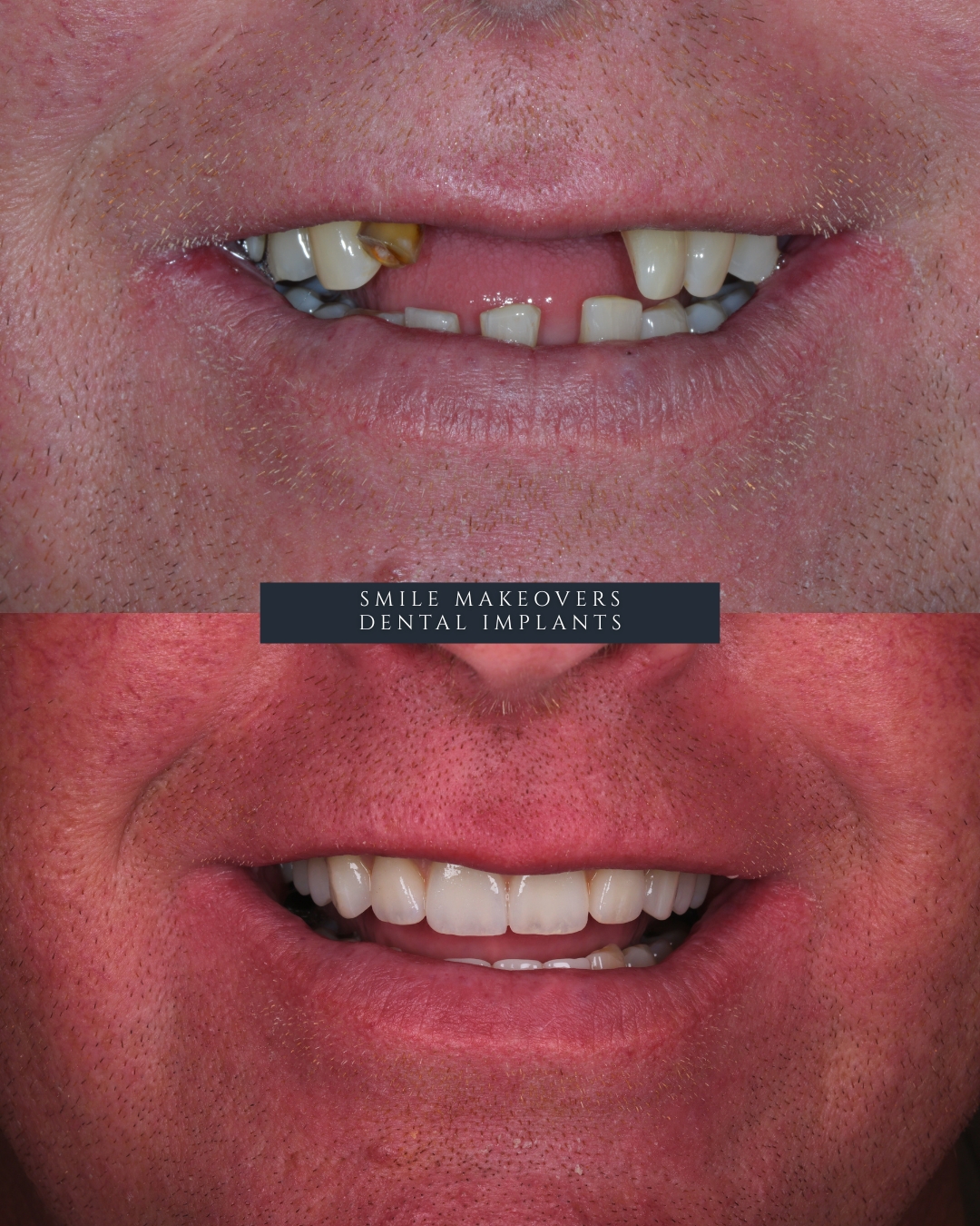 Dental Implants Harrogate