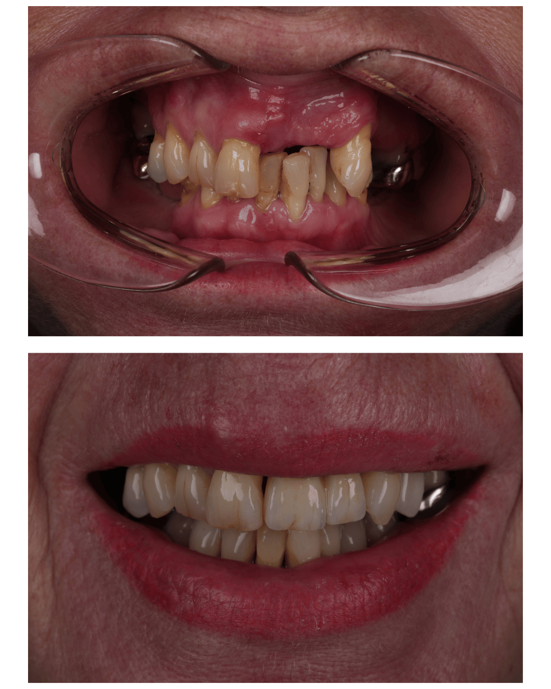 Dental Implants Harrogate