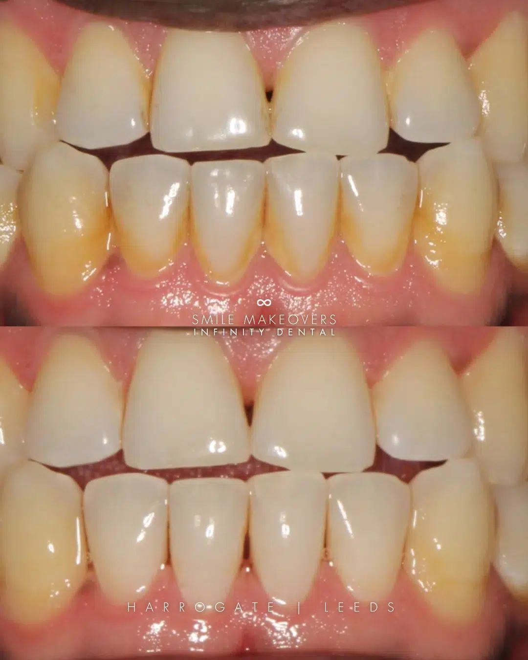 Full Arch Dental Implants Leeds and Harrogate before and after professional dental hygiene and gum disease treatment at Infinity Dental Clinic Leeds and Harrogate