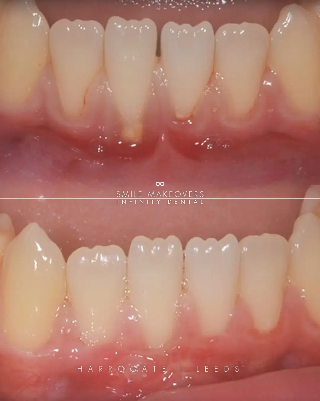 Full Arch Dental Implants Leeds and Harrogate before and after gum disease treatment and professional dental hygiene at Infinity Dental Clinic Leeds and Harrogate