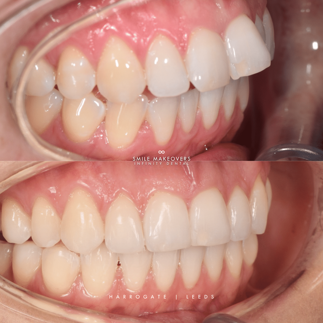 Invisalign orthodontic treatment results showing straighter teeth at Infinity Dental Clinic Leeds and Harrogate