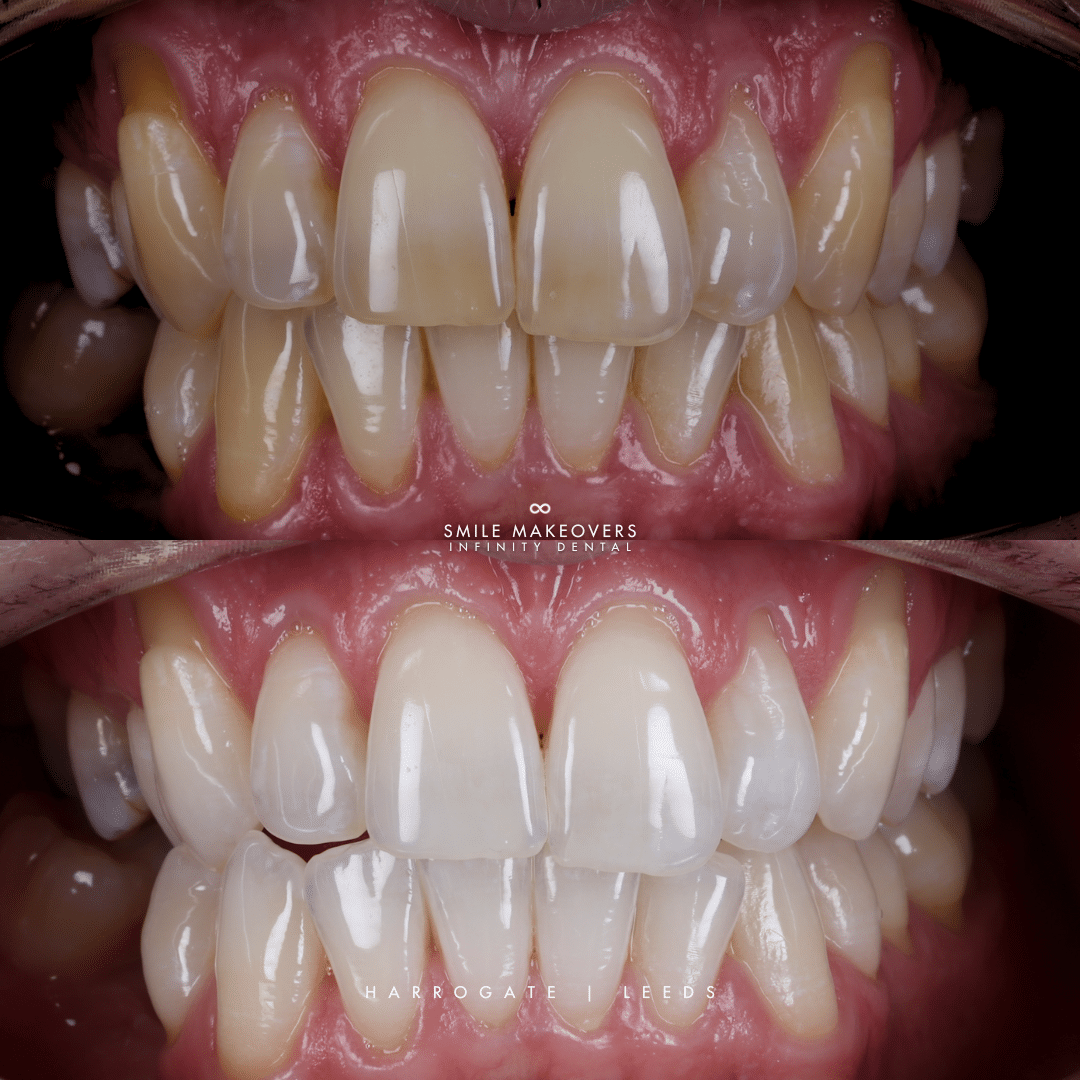 cosmetic dentistry smile makeover results at Infinity Dental Clinic Leeds and Harrogate