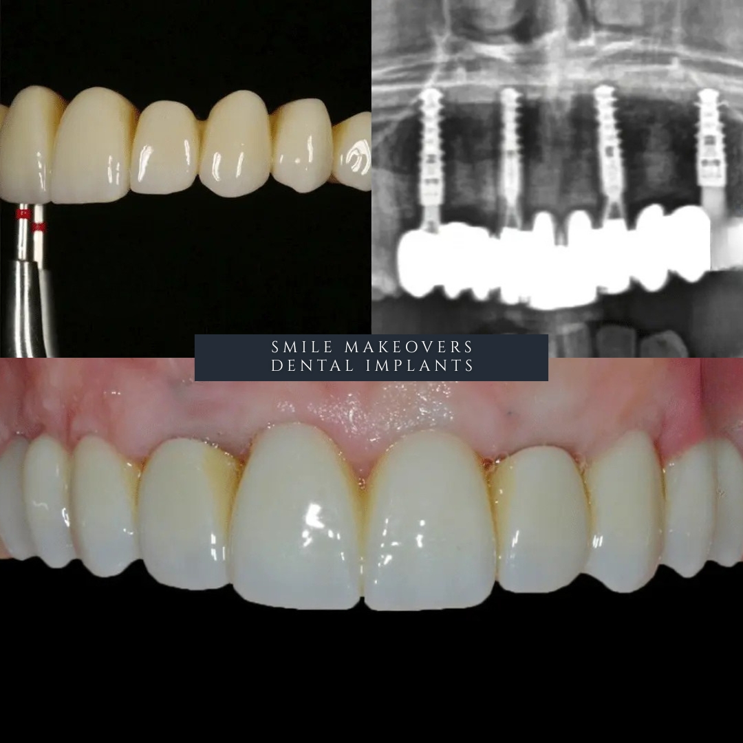 patient discussing full arch Same Day Teeth treatment at Infinity Dental Clinic Leeds and Harrogate