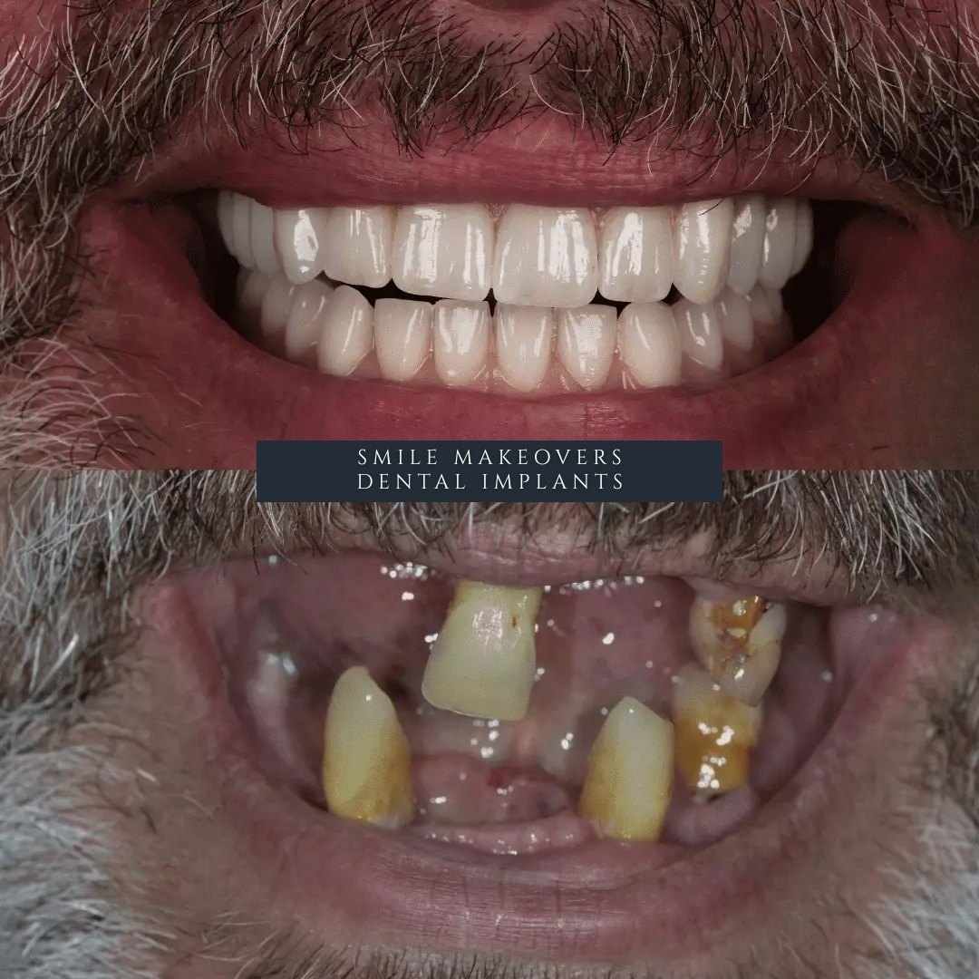 digital 3D scan and planning for full arch dental implants Leeds and Harrogate