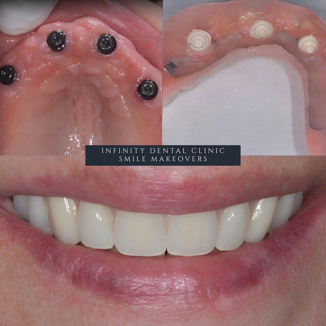 before and after results showing secure implant retained dentures Leeds and Harrogate