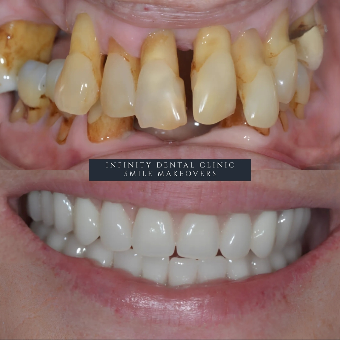 patient receiving implant retained denture fitting at Infinity Dental Clinic Leeds and Harrogate