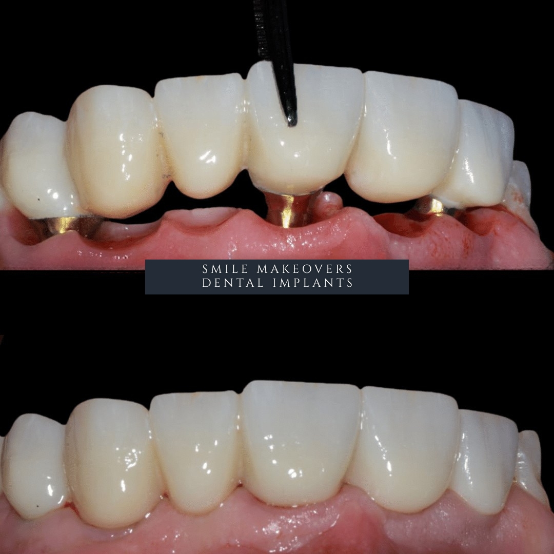 Dental implant surgery performed by the Infinity Dental Clinic team in Leeds