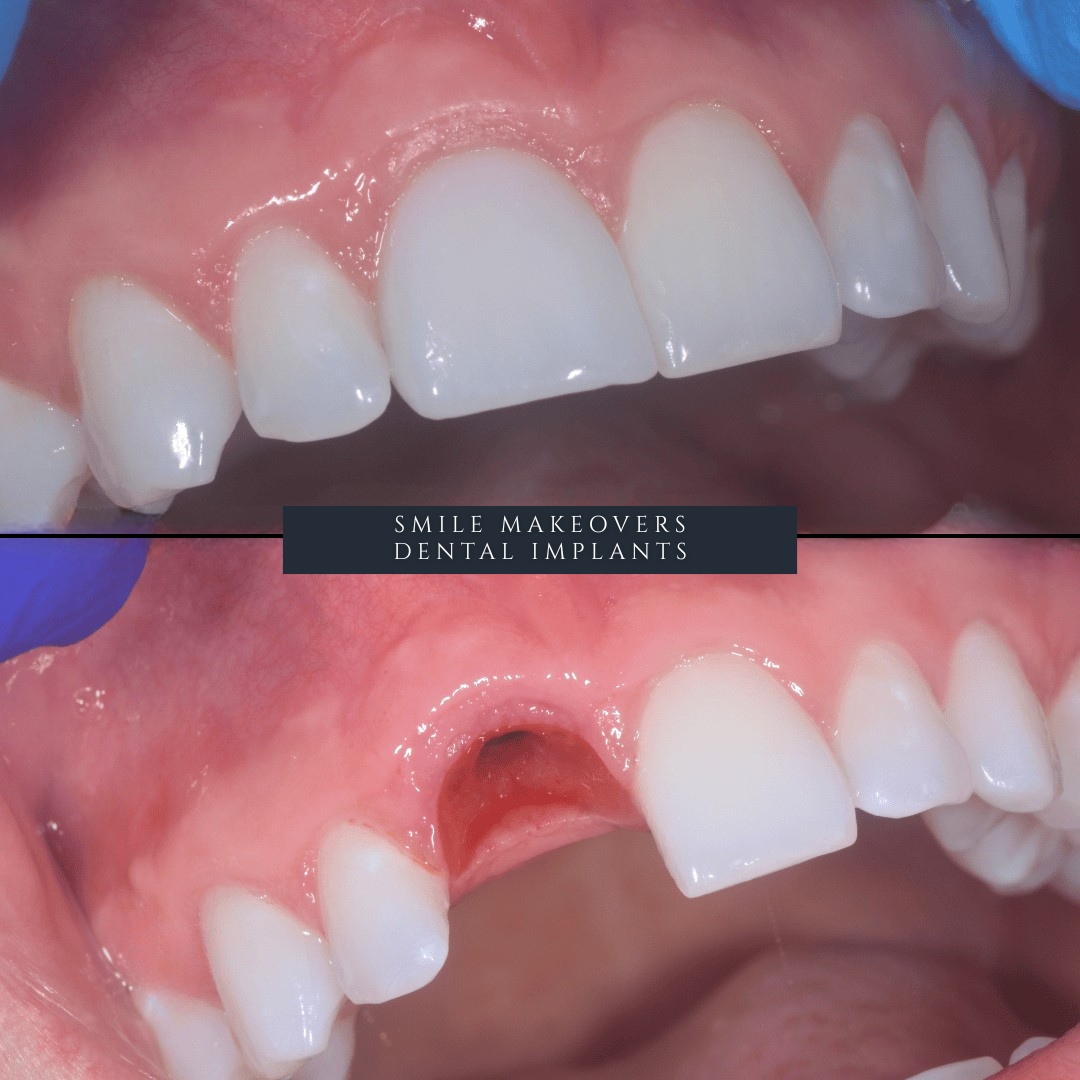 full mouth before and after dental implants restoration Leeds and Harrogate