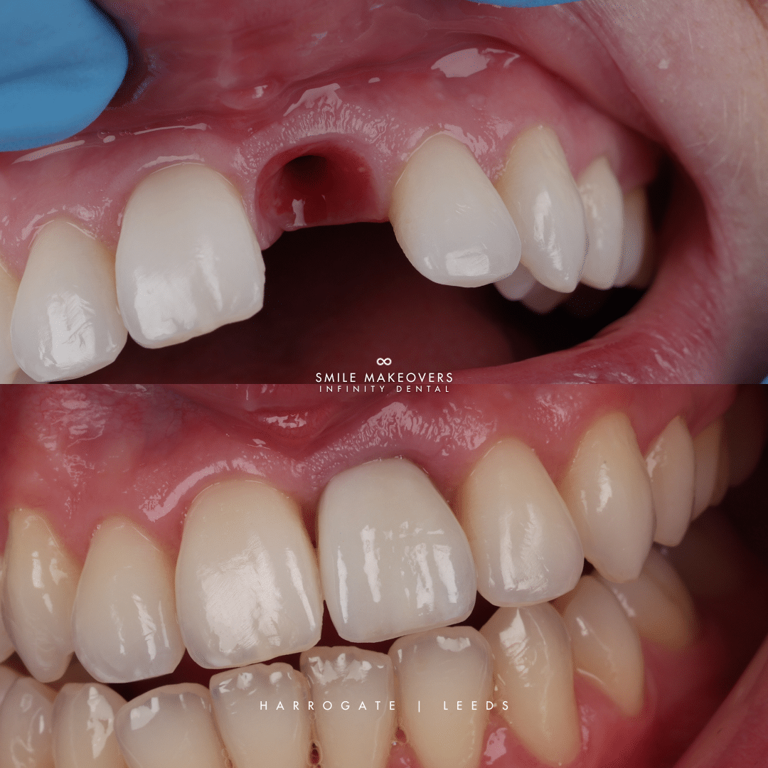 before and after Straumann dental implants fitted by Dr Mohsin Patel at Infinity Dental Clinic Leeds and Harrogate