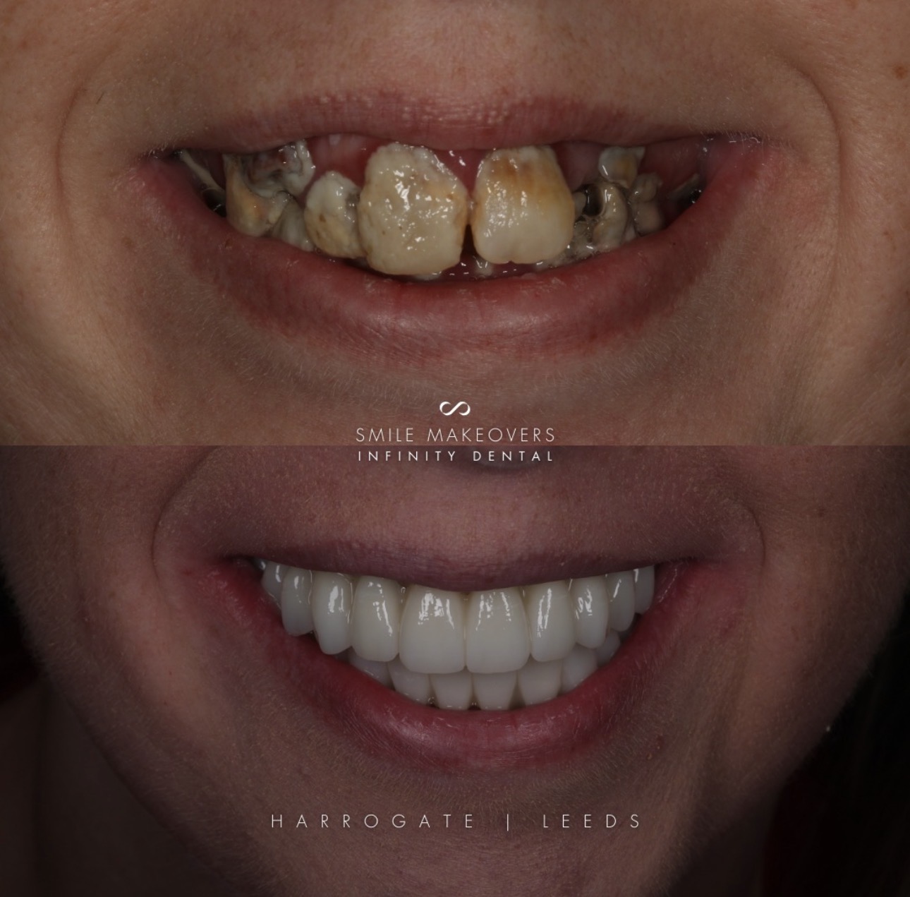 Full Arch Dental Implants Leeds and Harrogate before and after smile makeover using dental implants and cosmetic dentistry at Infinity Dental Clinic Leeds and Harrogate