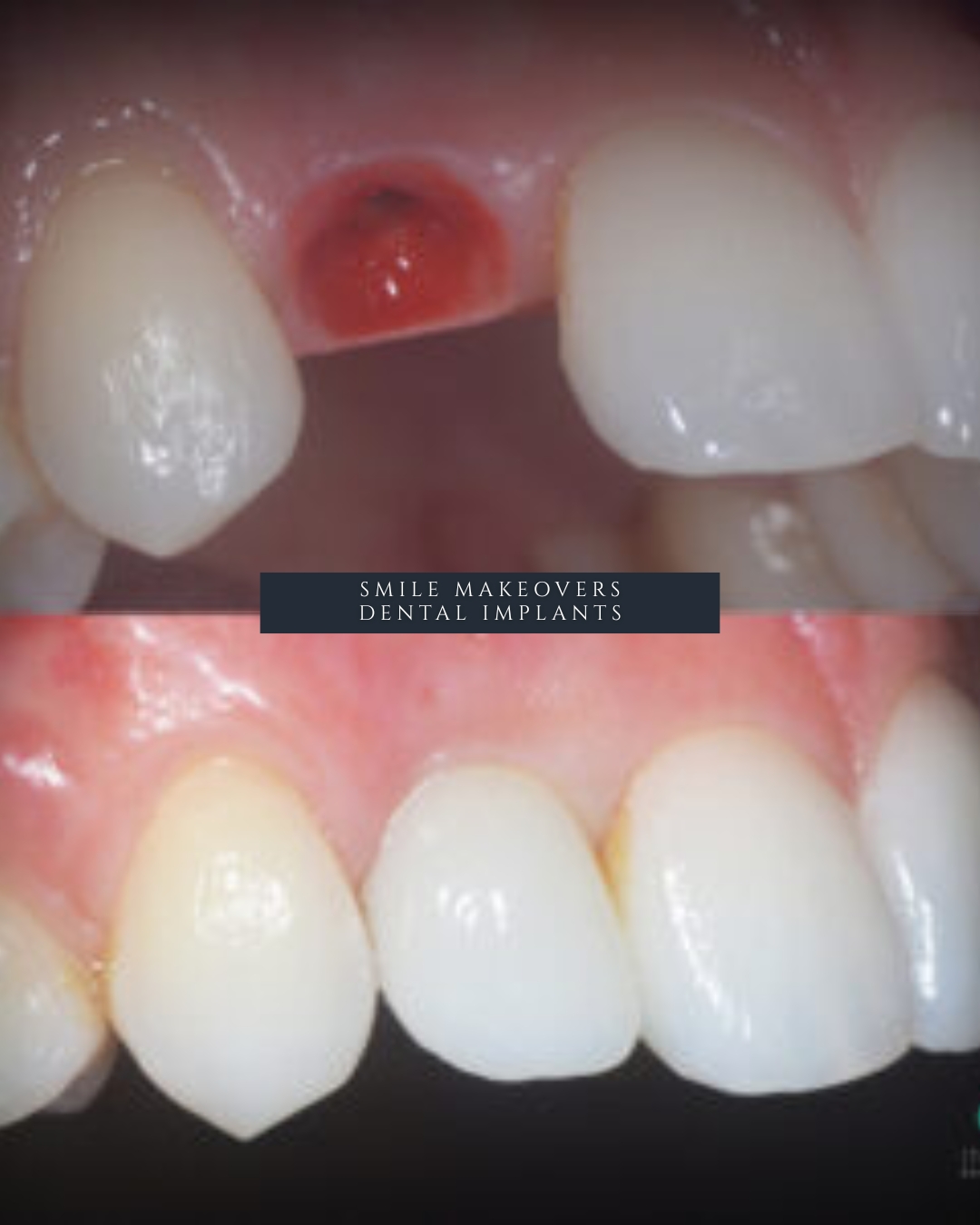 Dental Implants Harrogate