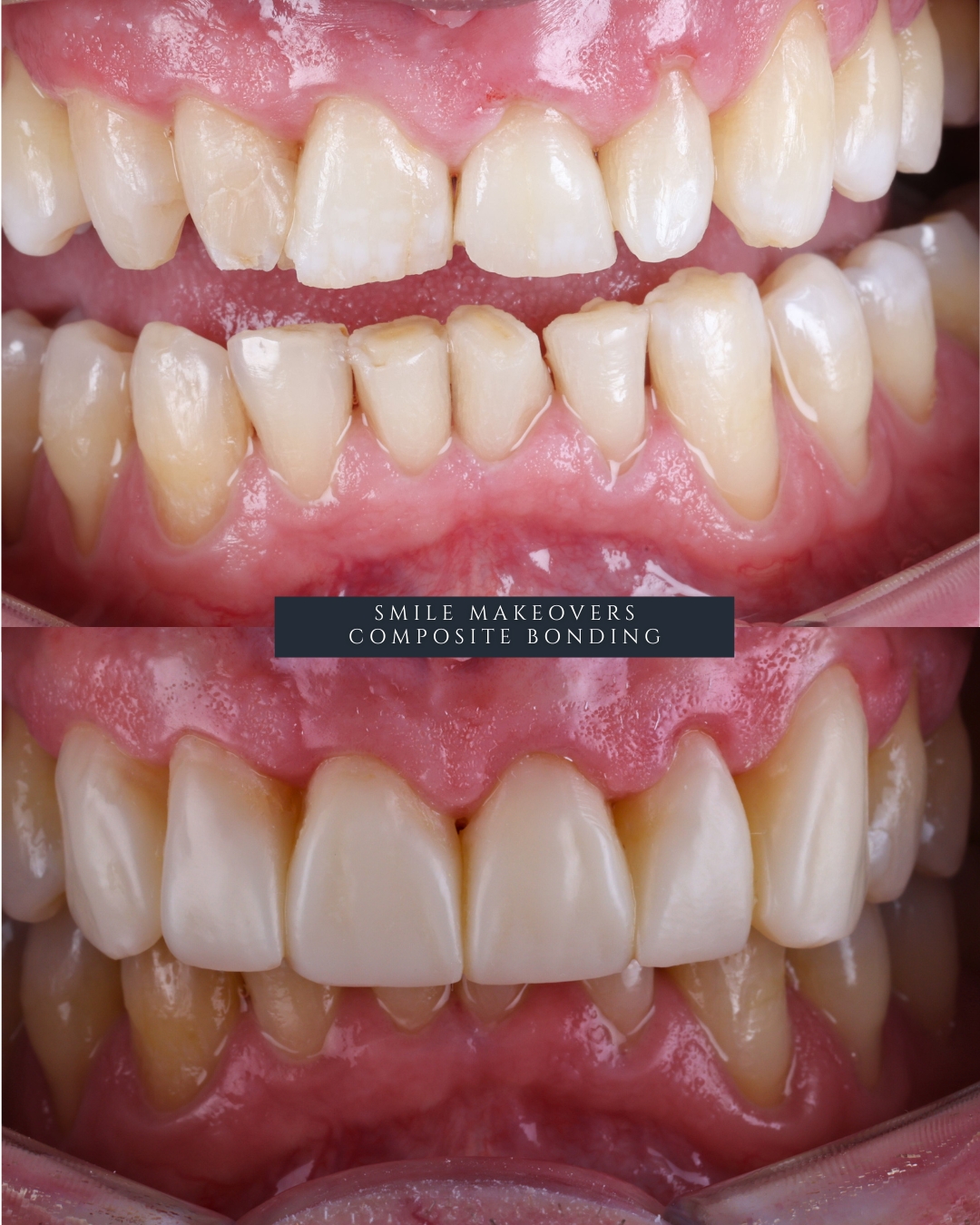 Before and after composite bonding treatment at Infinity Dental Clinic Leeds showing natural tooth reshaping and smile enhancement