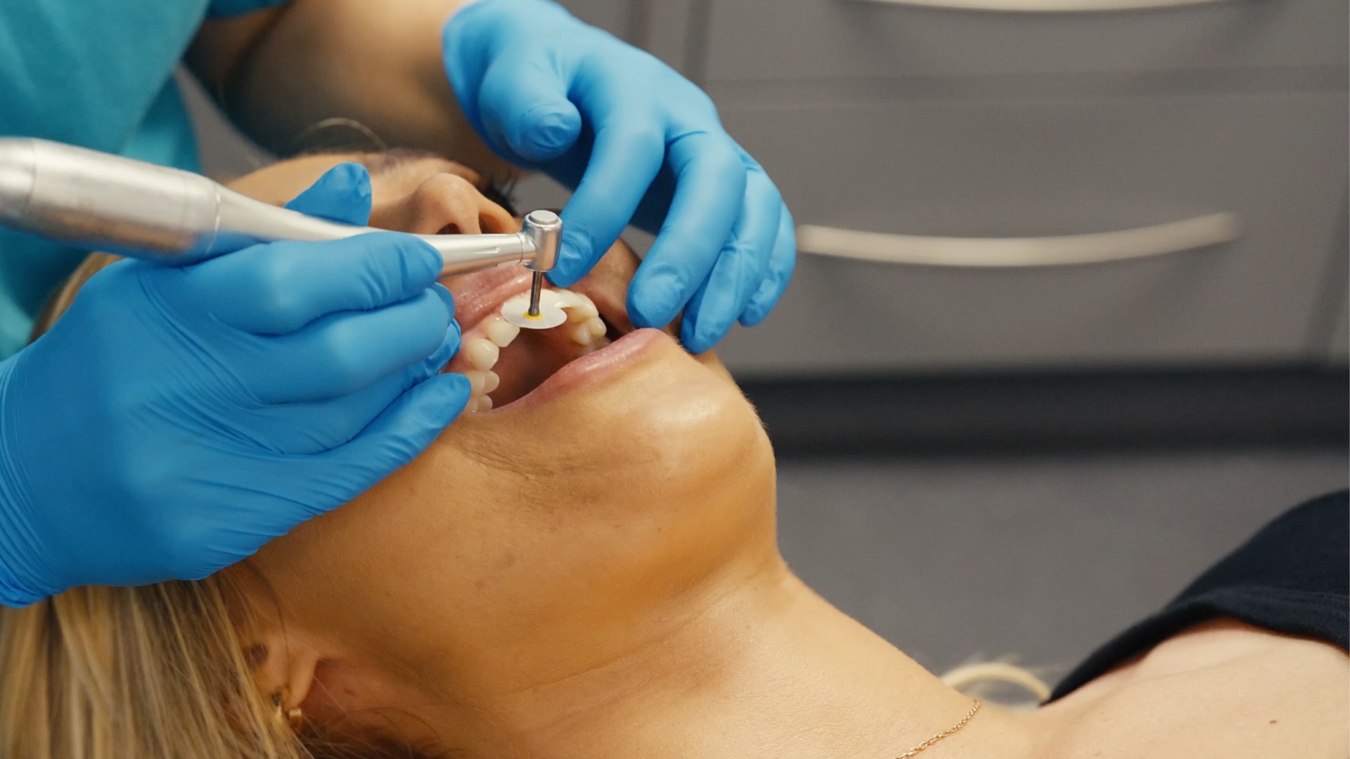 Composite Bonding performed at Infinity Dental Leeds and Harrogate