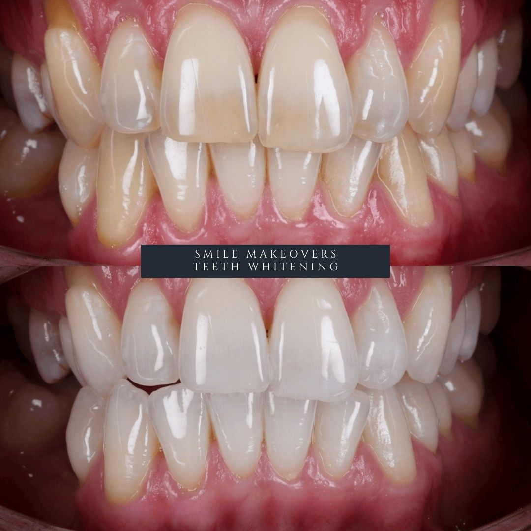 Before and after professional teeth whitening at Infinity Dental Clinic Leeds showing brighter, naturally white teeth and a confident smile