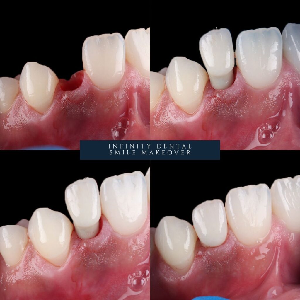 Infinity Implants Dental Implants | Replacing Teeth | Infinity Dental Leeds Harrogate