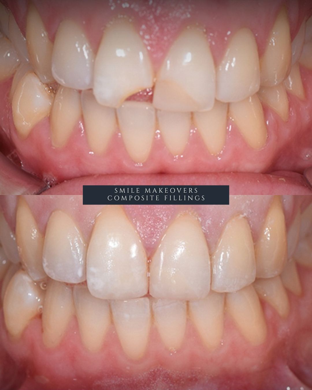 Full Arch Dental Implants Leeds and Harrogate Before and after composite filling showing natural tooth restoration at Infinity Dental in Leeds