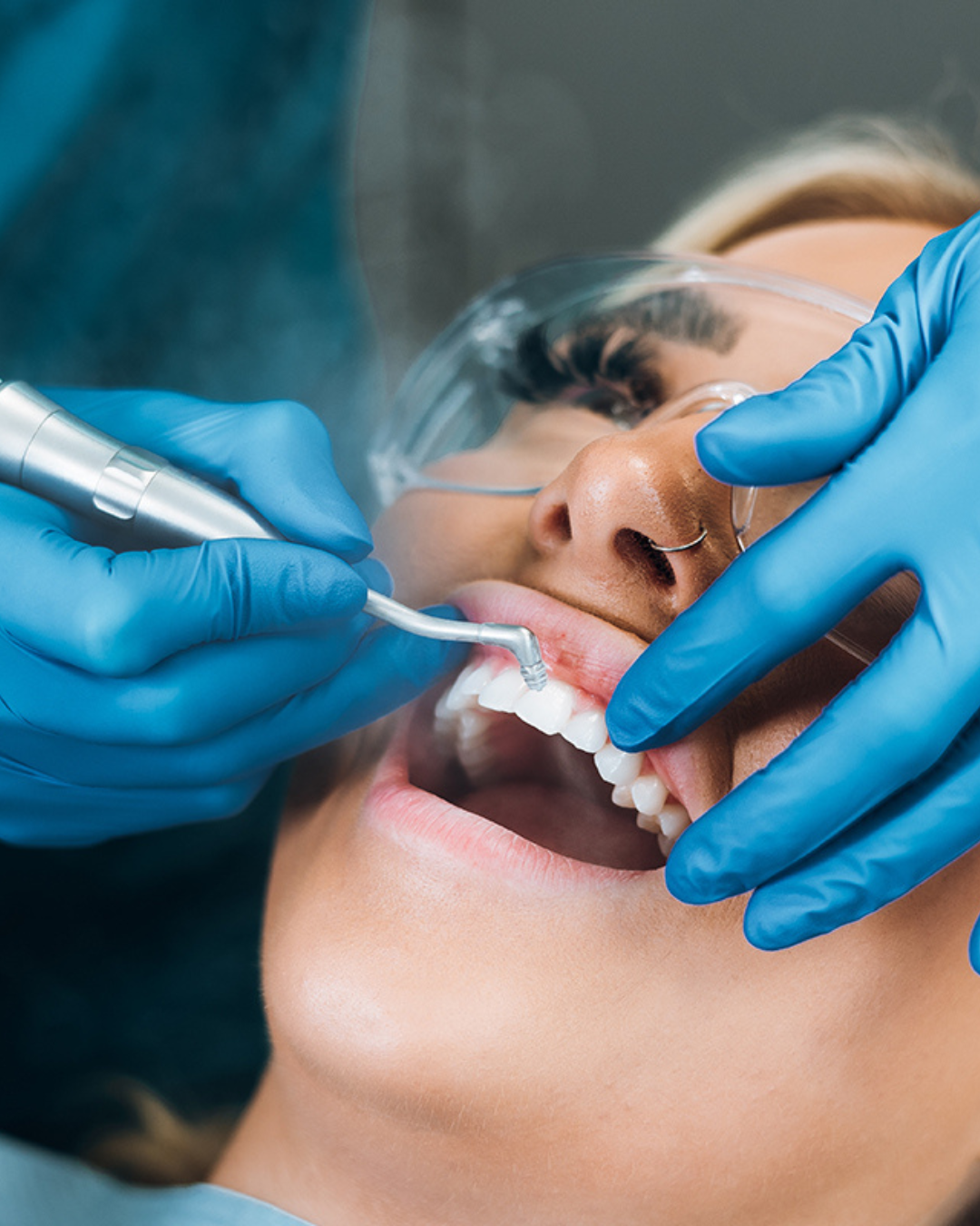 Full Arch Dental Implants Leeds and Harrogate Before and after example of a glass ionomer filling used as a temporary restoration in a tooth at Infinity Dental Leeds