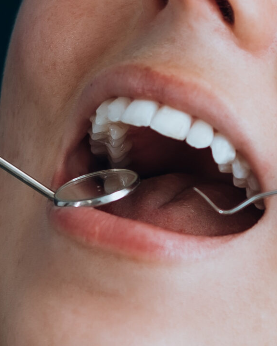 Full Arch Dental Implants Leeds and Harrogate Patient receiving a dental checkup at Infinity Dental Clinic in Leeds and Harrogate