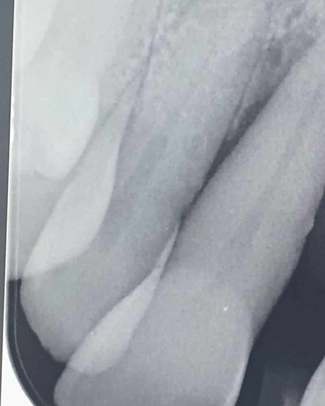 Full Arch Dental Implants Leeds and Harrogate Dental X ray showing a tooth assessment at Infinity Dental Clinic in Leeds and Harrogate