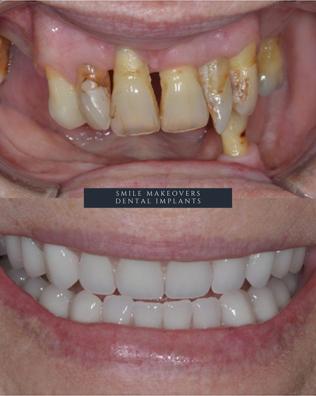 Full Arch Dental Implants Leeds and Harrogate Before and after dental implants showing tooth replacement results at Infinity Dental Clinic in Leeds and Harrogate