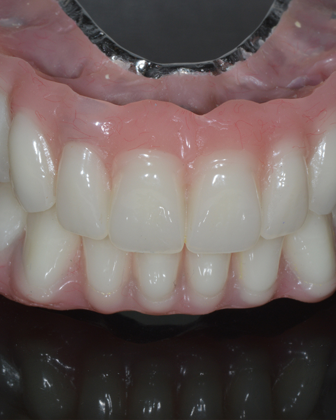 Full Arch Dental Implants Leeds and Harrogate Removable dentures used to replace missing teeth at Infinity Dental Clinic in Leeds and Harrogate