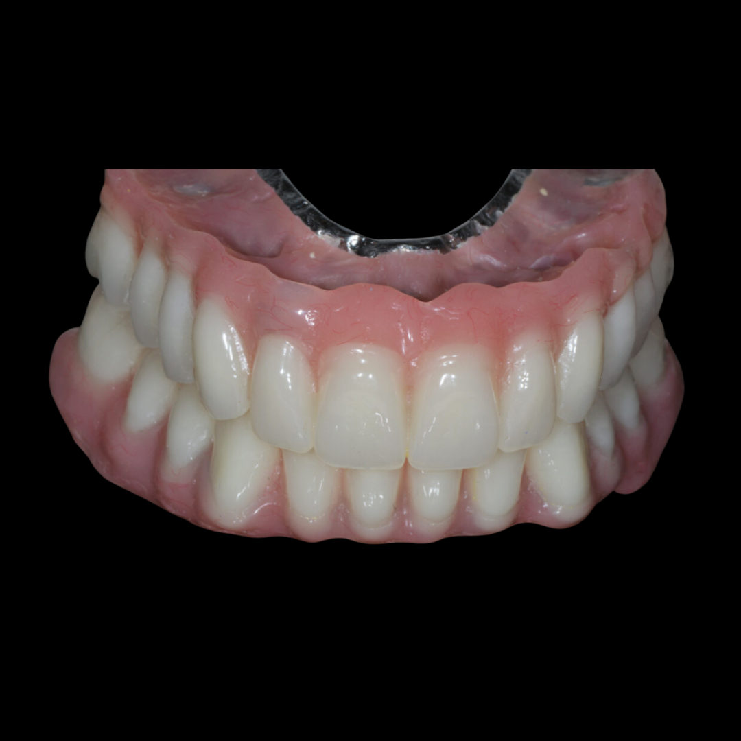 Dentures used to replace missing teeth at Infinity Dental Clinic in Leeds