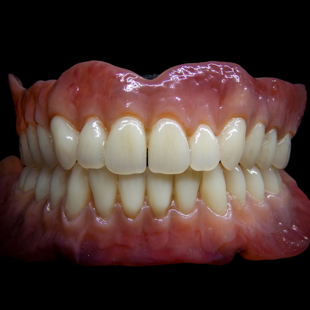 Full Arch Dental Implants Leeds and Harrogate Standard acrylic dentures available at Infinity Dental Clinic in Leeds
