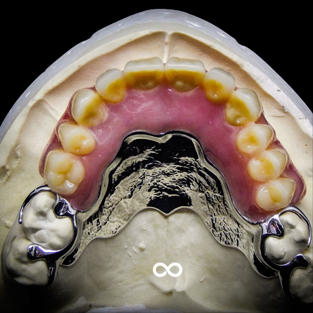 Full Arch Dental Implants Leeds and Harrogate Cobalt chrome metal denture with lightweight framework at Infinity Dental Clinic in Leeds