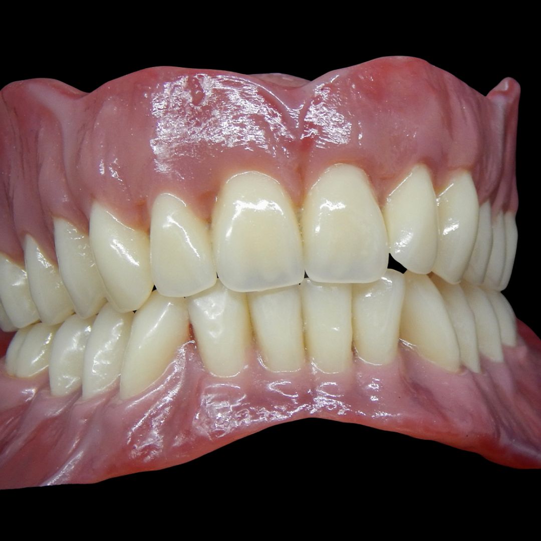 Full Arch Dental Implants Leeds and Harrogate Compressed acrylic dentures with natural appearance at Infinity Dental Clinic in Leeds