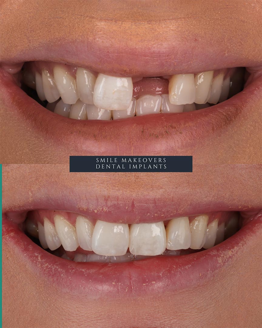 dental implants leeds harrogate