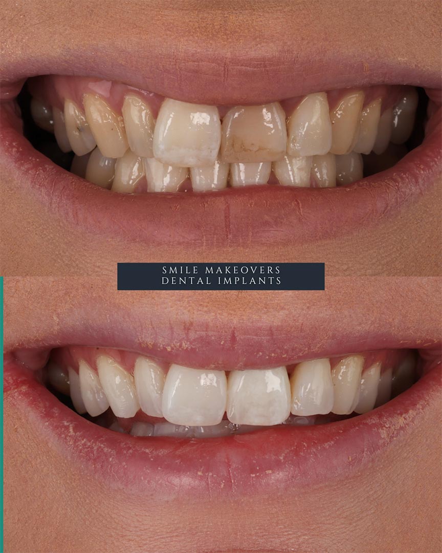 dental implants leeds harrogate