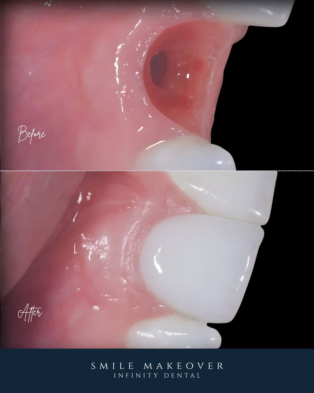 Full Arch Dental Implants Leeds and Harrogate