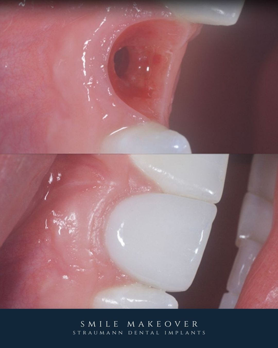 Full Arch Dental Implants Leeds and Harrogate Before and after full arch dental implants at Infinity Dental Clinic Leeds