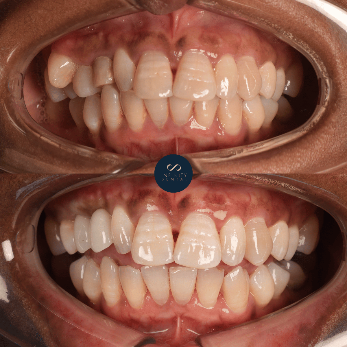 before and after front tooth dental implant restoration Leeds and Harrogate